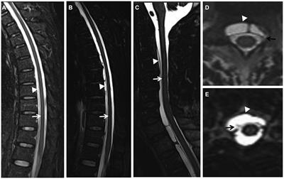 Infratentorial superficial siderosis: report of six cases and review of the literature